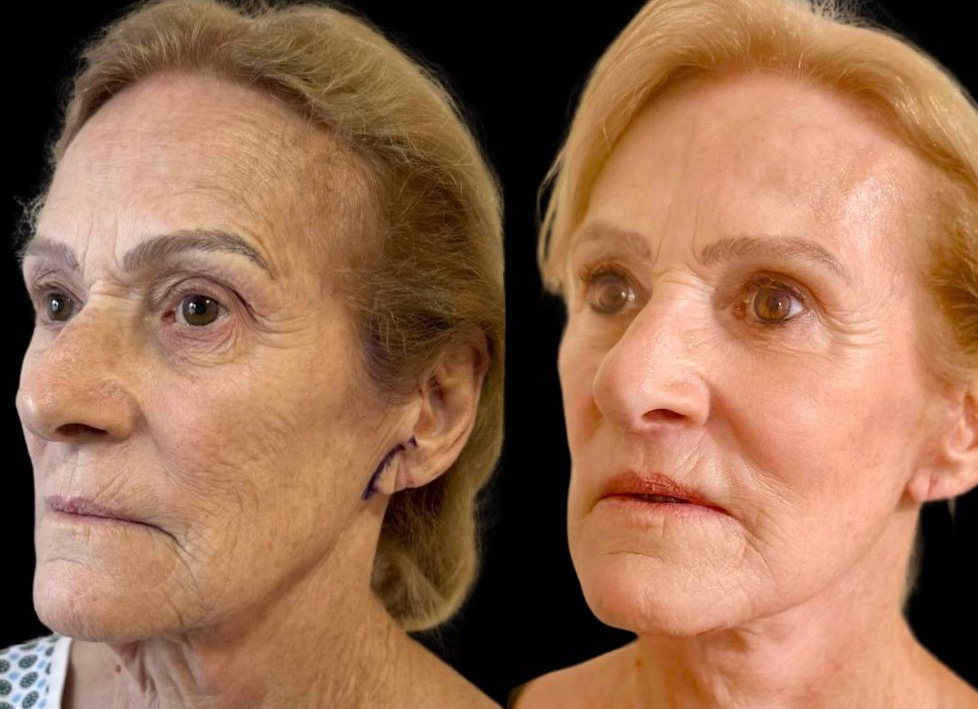 facelift-75-yr-female-before-after-left-three-quarter-view.jpg