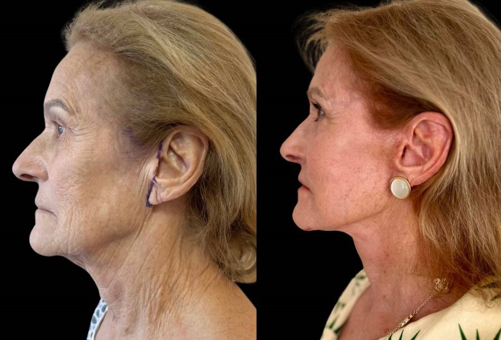 facelift-75-yr-female-before-after-left-view.jpg