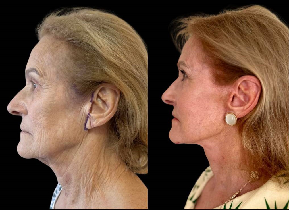 facelift-75-yr-female-before-after-left-view.jpg