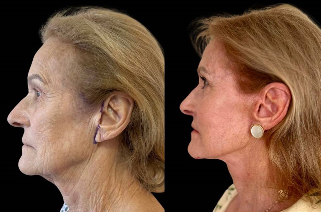facelift-75-yr-female-before-after-left-view.jpg