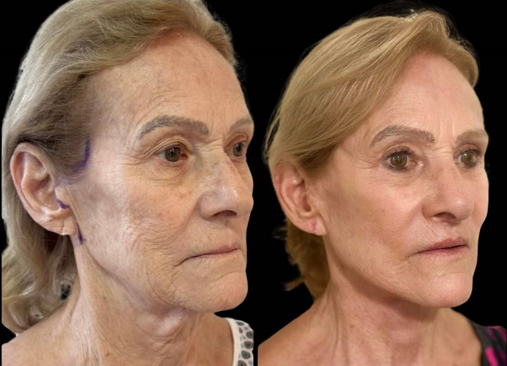 facelift-75-yr-female-before-after-right-three-quarter-view.jpg