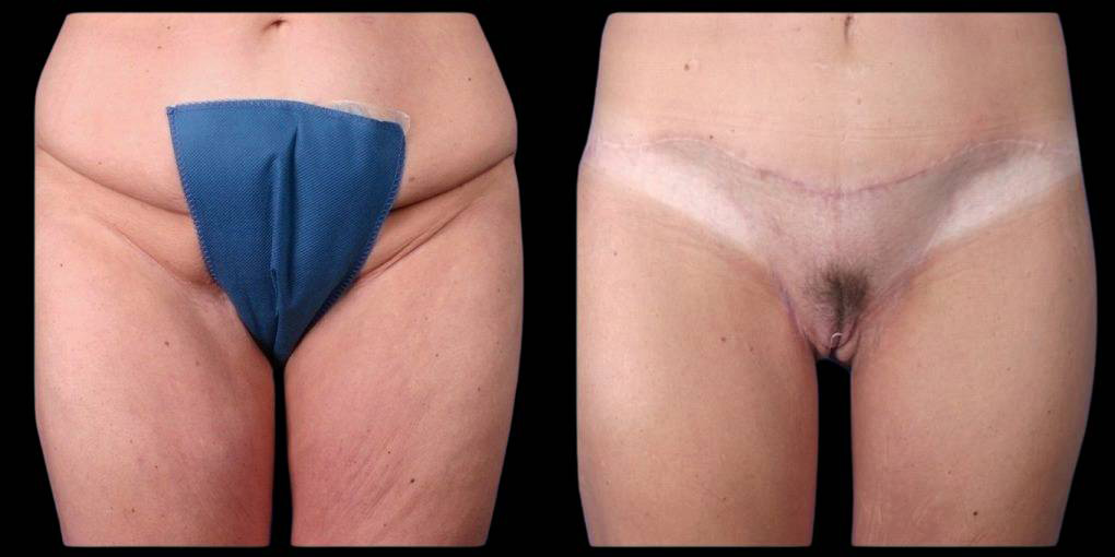 This is a female that has had a tummy tuck after weight loss showing the before and after's side-by-side