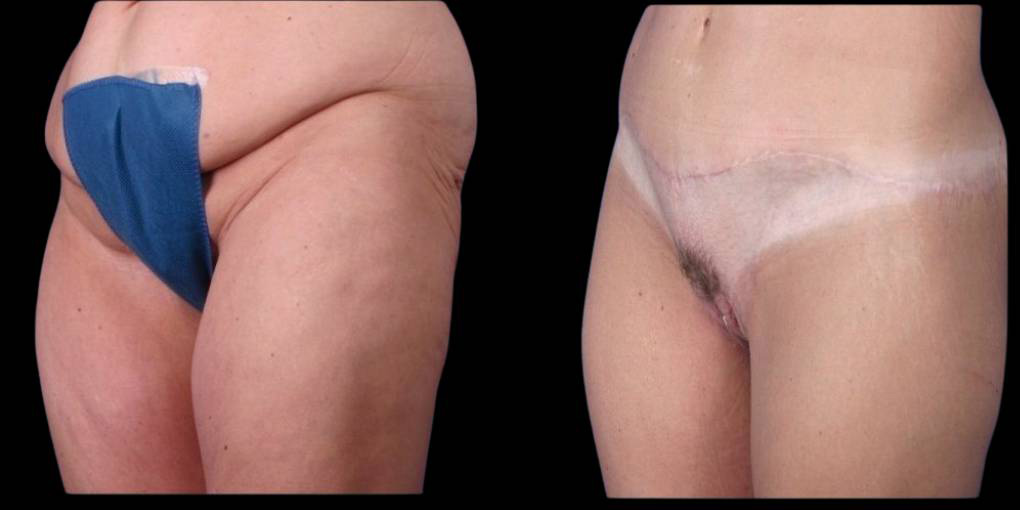 This is a female that has had a tummy tuck after weight loss showing the before and after's side-by-side