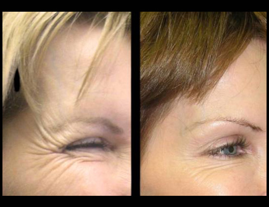 female-botox-before-and-after-front-view-2.jpg.jpg