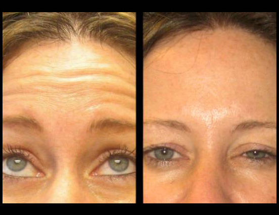 female-botox-before-and-after-front-view-3.jpg.jpg