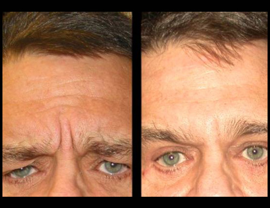 female-botox-before-and-after-front-view-4.jpg.jpg