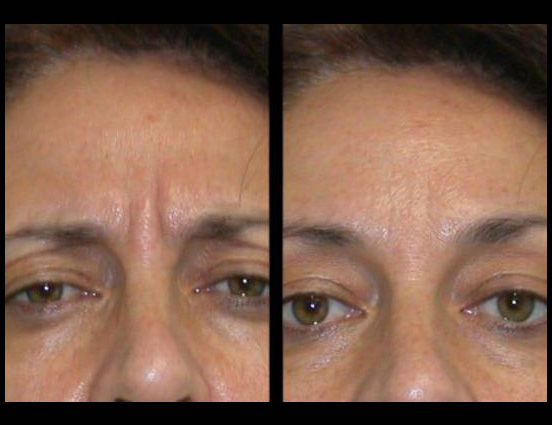 female-botox-before-and-after-front-view-6.jpg.jpg