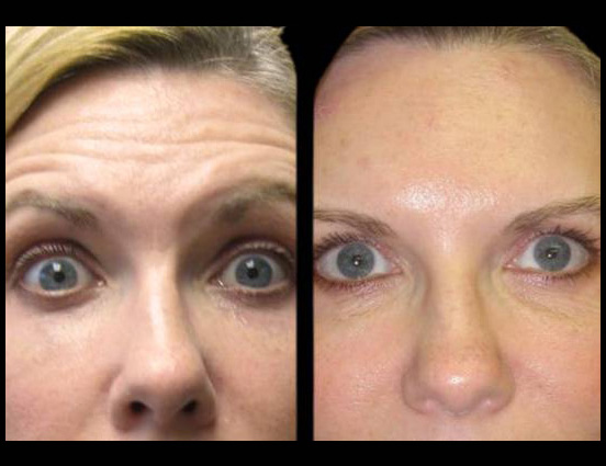 female-botox-before-and-after-front-view-7.jpg.jpg