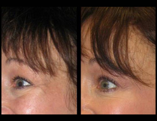 female-botox-before-and-after-front-view-8.jpg.jpg
