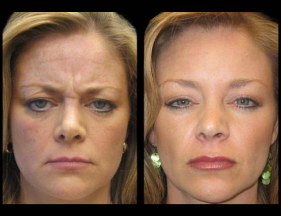 female-botox-before-and-after-front-view.jpg.jpg