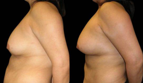 female-breast-implant-exchange-before-and-after-side-view-3.jpg