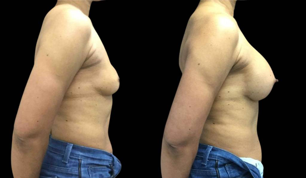female-breast-implant-exchange-before-and-after-side-view.jpg