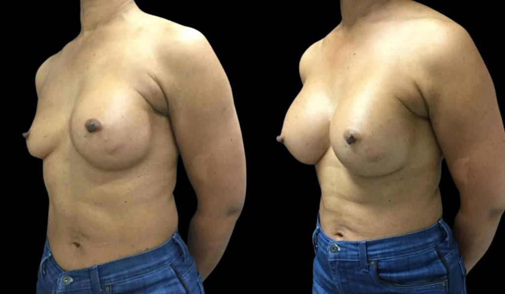 female-breast-implant-exchange-before-and-after-three-quarter-view.jpg