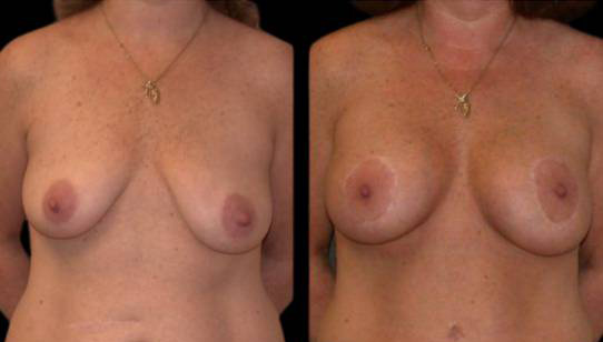 female-breast-lift-with-augmentation-before-and-after-front-view-1.jpg
