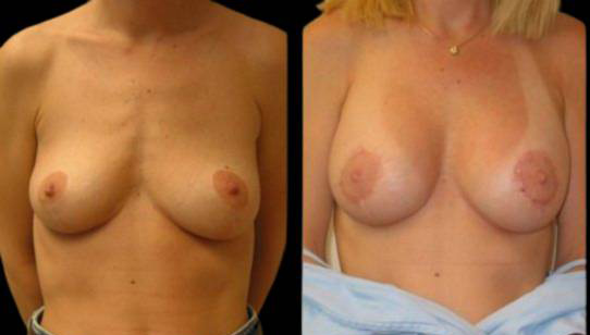 female-breast-lift-with-augmentation-before-and-after-front-view-2.jpg