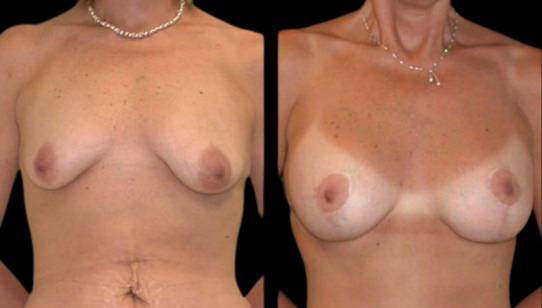 female-breast-lift-with-augmentation-before-and-after-front-view.jpg