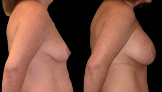 female-breast-lift-with-augmentation-before-and-after-side-view-1.jpg