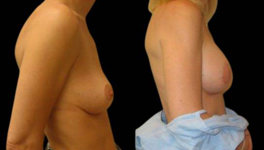 female-breast-lift-with-augmentation-before-and-after-side-view-2.jpg