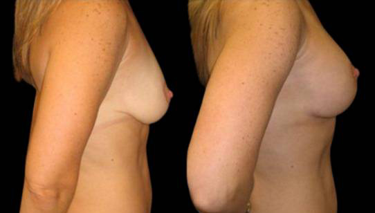 female-breast-lift-with-augmentation-before-and-after-side-view-4.jpg