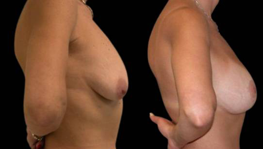 female-breast-lift-with-augmentation-before-and-after-side-view.jpg