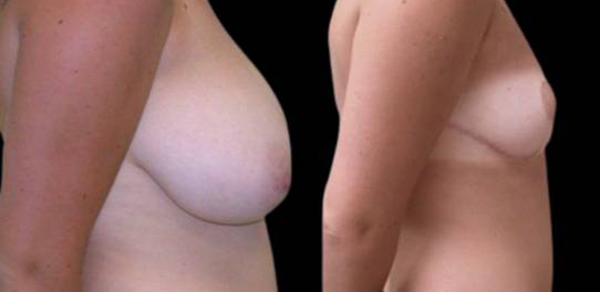 female-breast-reduction-before-and-after-side-view-1.jpg