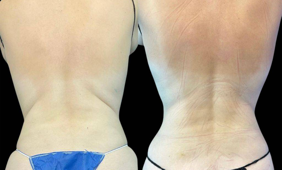 female-coolsculpting-before-and-after-front-view-3.jpg