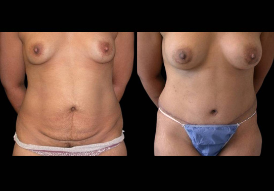 This is a female that has had an extreme makeover cosmetic surgery showing the before and after's side-by-side