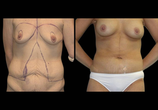 This is a female that has had an extreme makeover cosmetic surgery showing the before and after's side-by-side