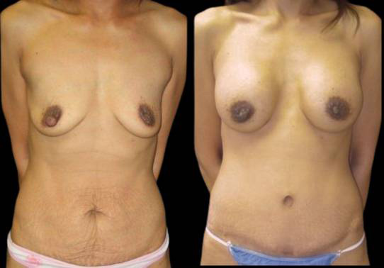 This is a female that has had an extreme makeover cosmetic surgery showing the before and after's side-by-side