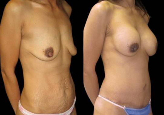 This is a female that has had an extreme makeover cosmetic surgery showing the before and after's side-by-side