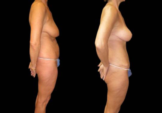 This is a female that has had an extreme makeover cosmetic surgery showing the before and after's side-by-side