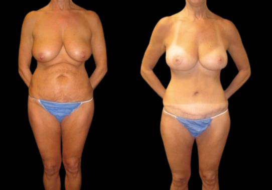 This is a female that has had an extreme makeover cosmetic surgery showing the before and after's side-by-side