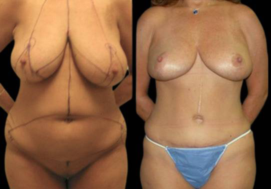 This is a female that has had an extreme makeover cosmetic surgery showing the before and after's side-by-side