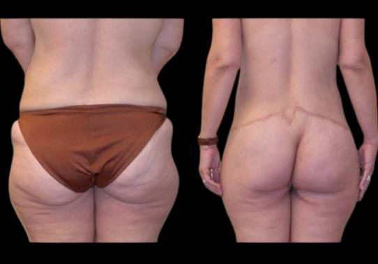 This is a female that has had an extreme makeover cosmetic surgery showing the before and after's side-by-side