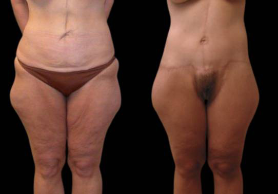 This is a female that has had an extreme makeover cosmetic surgery showing the before and after's side-by-side