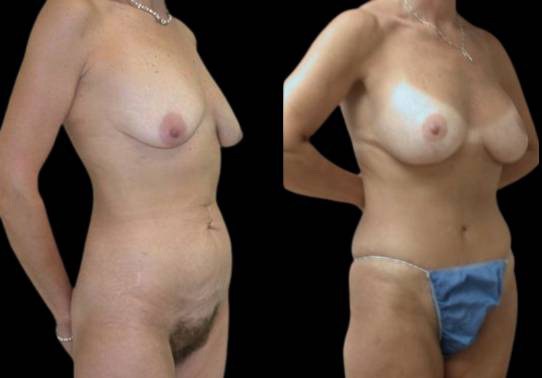 This is a female that has had an extreme makeover cosmetic surgery showing the before and after's side-by-side