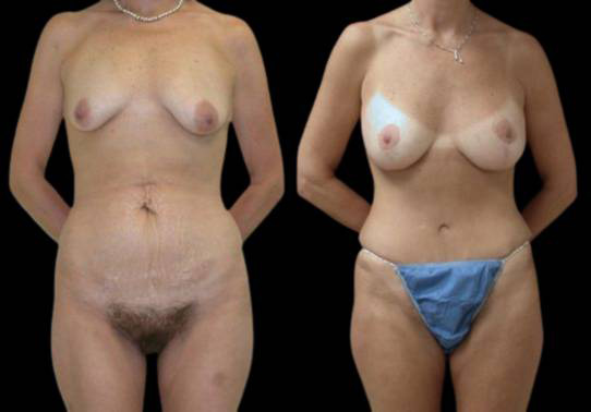 This is a female that has had an extreme makeover cosmetic surgery showing the before and after's side-by-side