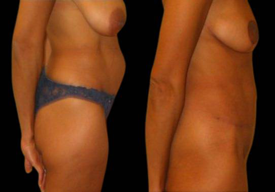 This is a female that has had an extreme makeover cosmetic surgery showing the before and after's side-by-side