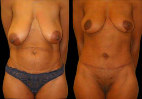 This is a female that has had an extreme makeover cosmetic surgery showing the before and after's side-by-side