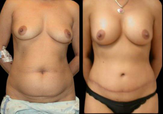 This is a female that has had an extreme makeover cosmetic surgery showing the before and after's side-by-side