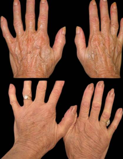 female-hand-rejuvenation-before-and-after-1