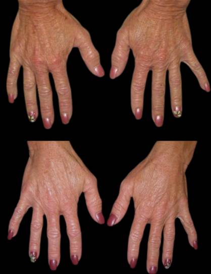female-hand-rejuvenation-before-and-after