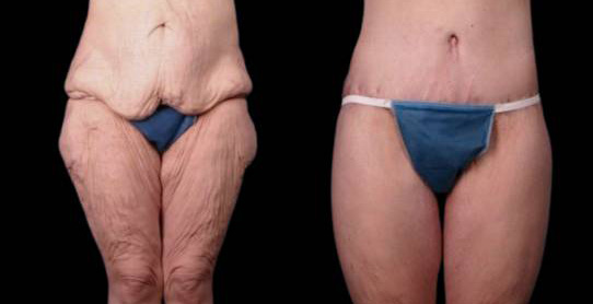 female-inner-thigh-lift-before-and-after-1.jpg