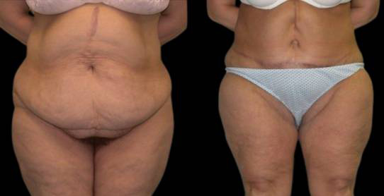female-inner-thigh-lift-before-and-after-7.jpg