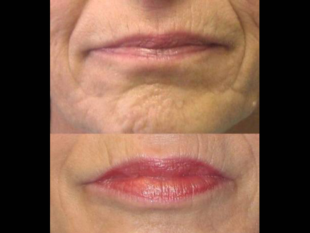 female-juvederm-before-and-after-front-view-1.jpg