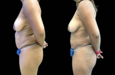 female-laser-lipo-before-and-after-front-view.jpg