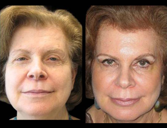 female-non-surgical-facelift-before-and-after-front-view.jpg