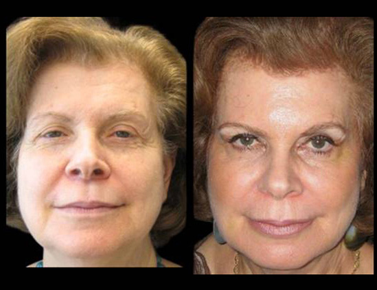 female-non-surgical-facelift-before-and-after-front-view.jpg
