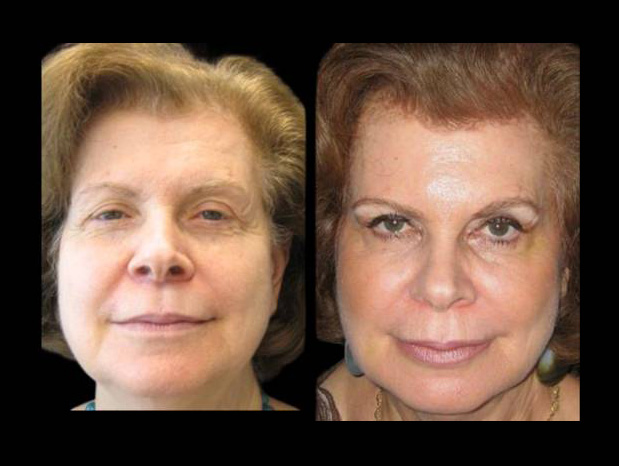 female-non-surgical-facelift-before-and-after-front-view.jpg