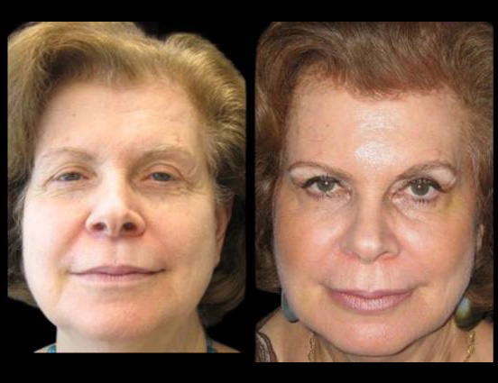female-non-surgical-facelift-before-and-after-front-view.jpg.jpg